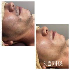 男性 顔脱毛Before After