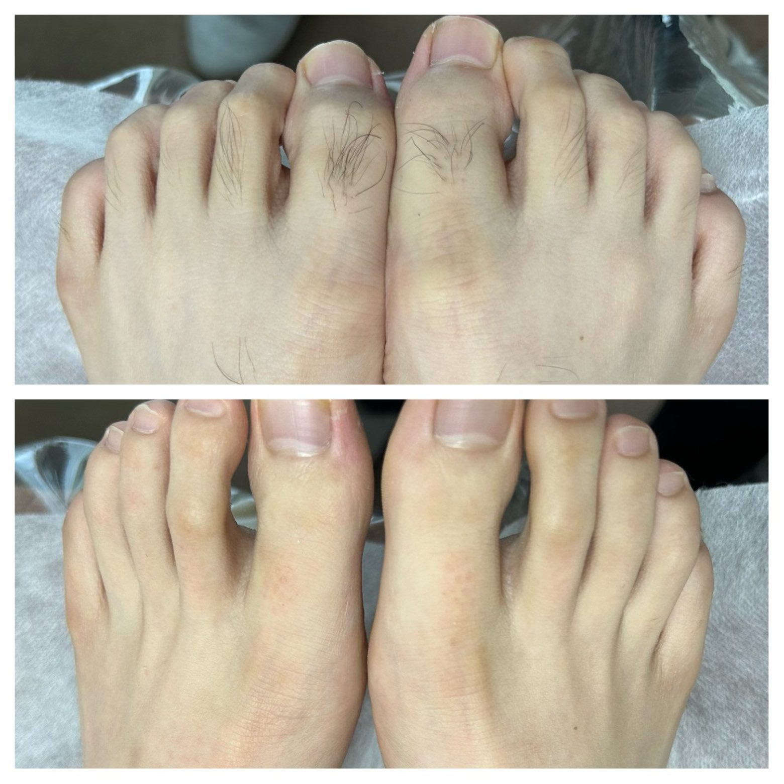 メンズ 足指甲 wax脱毛