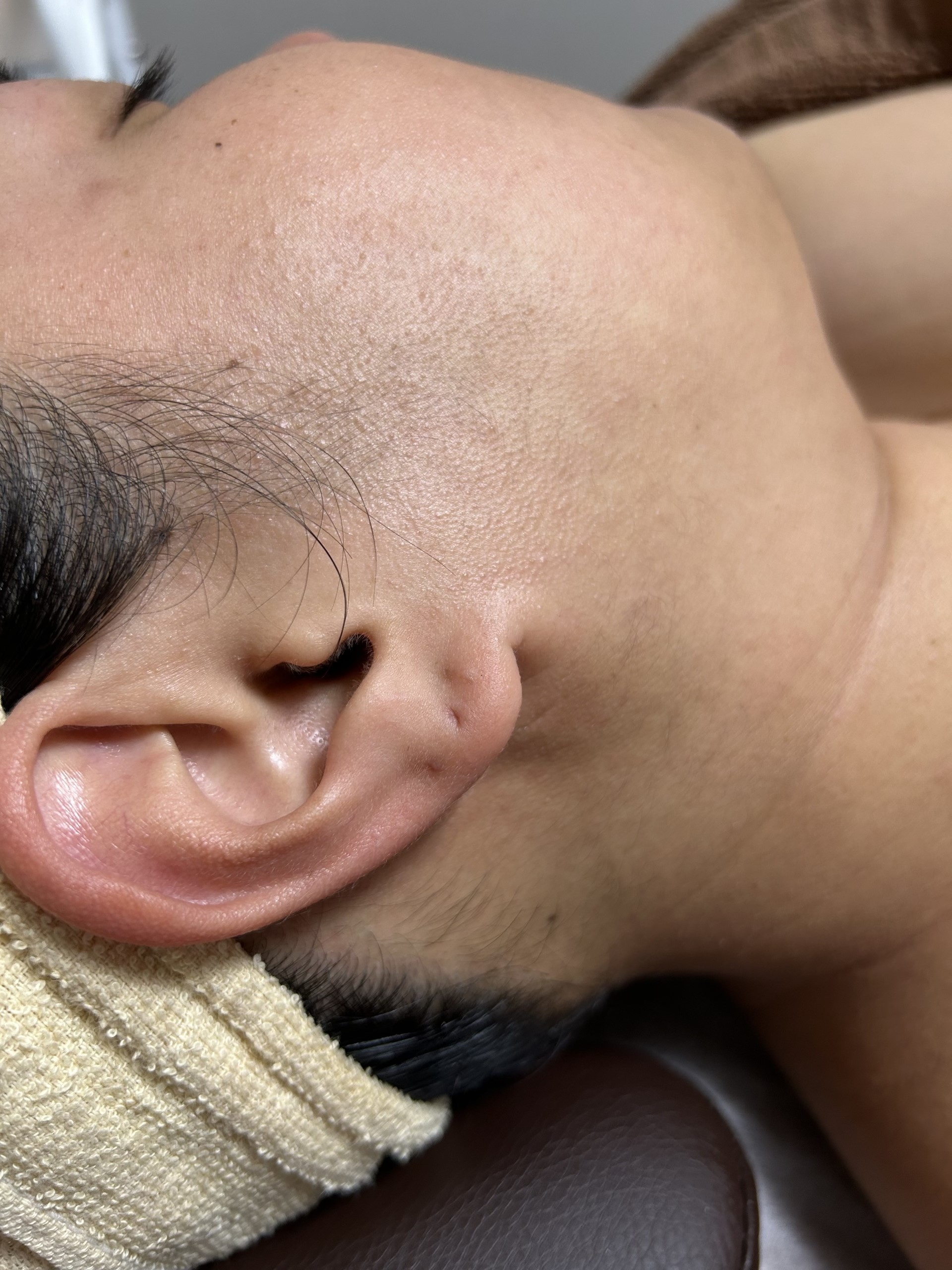もみ上げ+うなじ wax脱毛