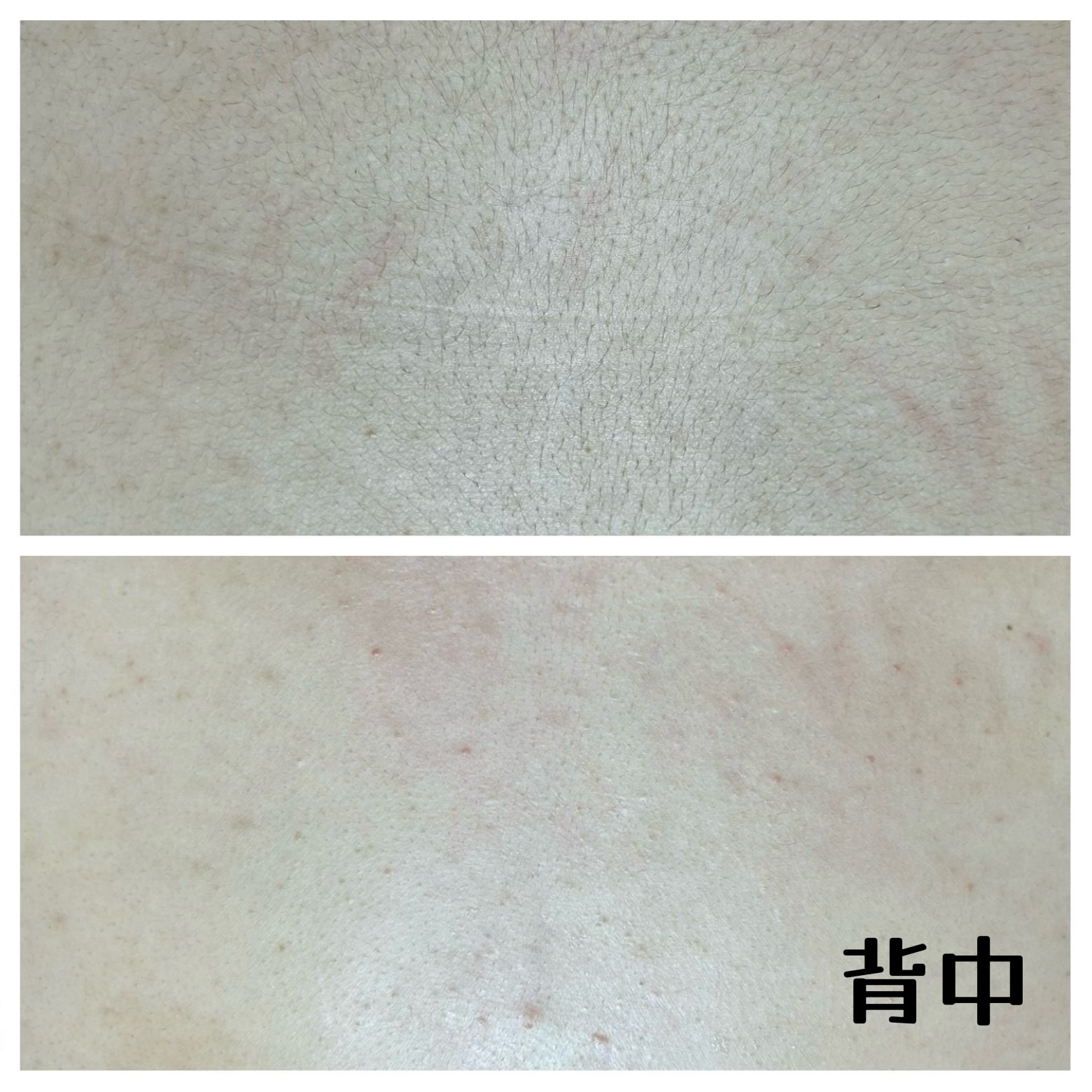 背中all wax脱毛