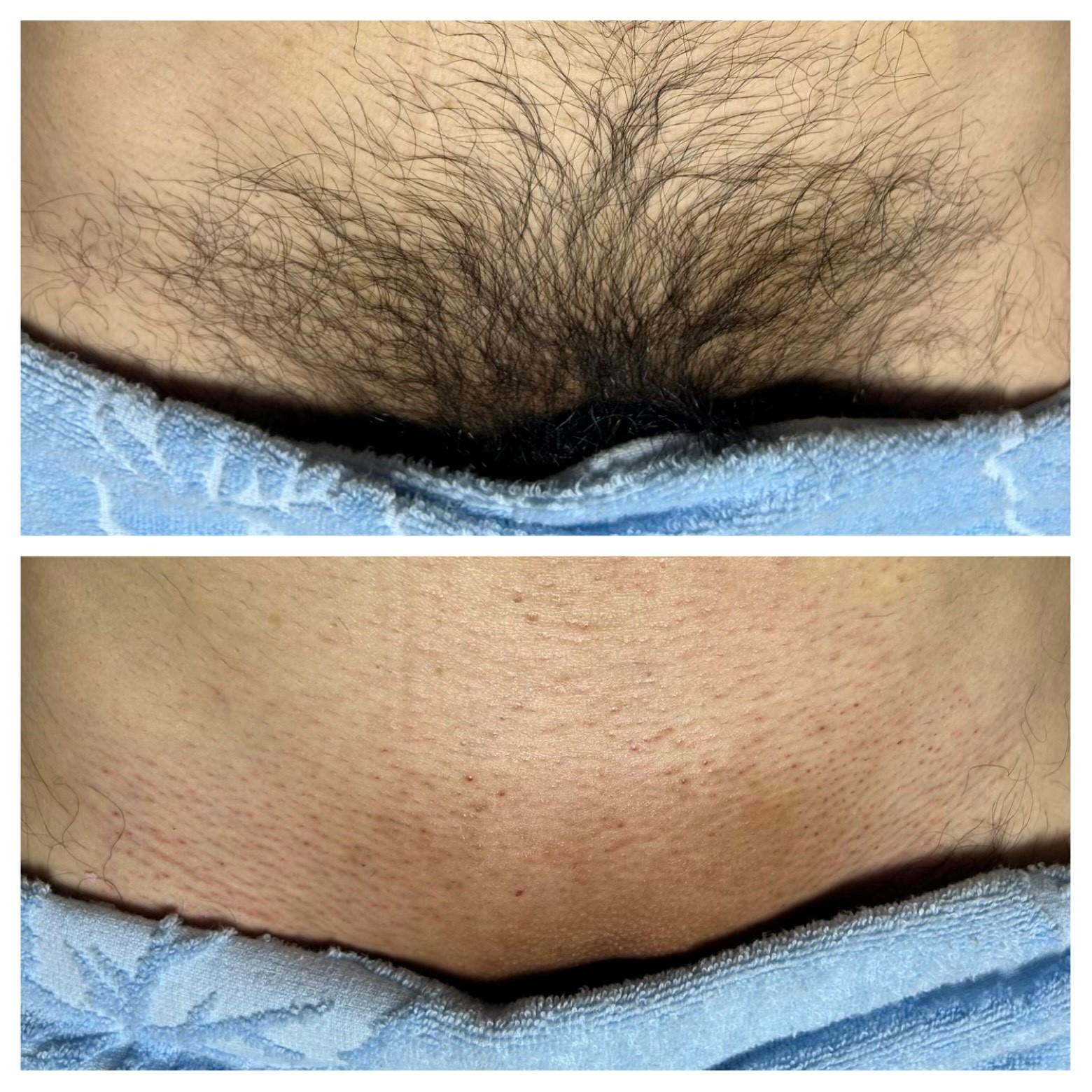 メンズ ブラジリアン wax脱毛