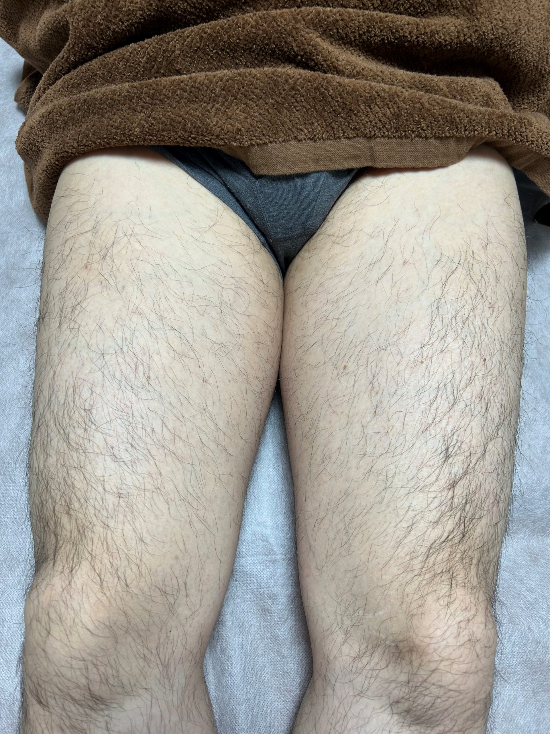 メンズ ひざ上 wax脱毛