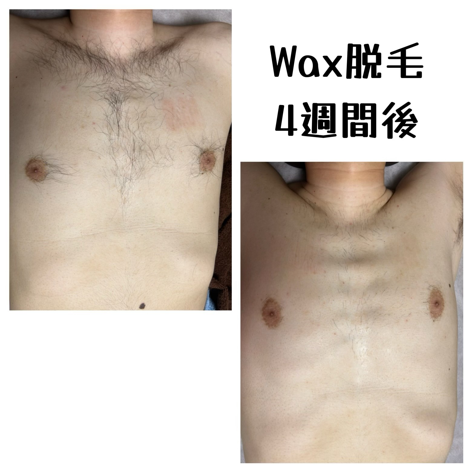 メンズ 胸 wax脱毛