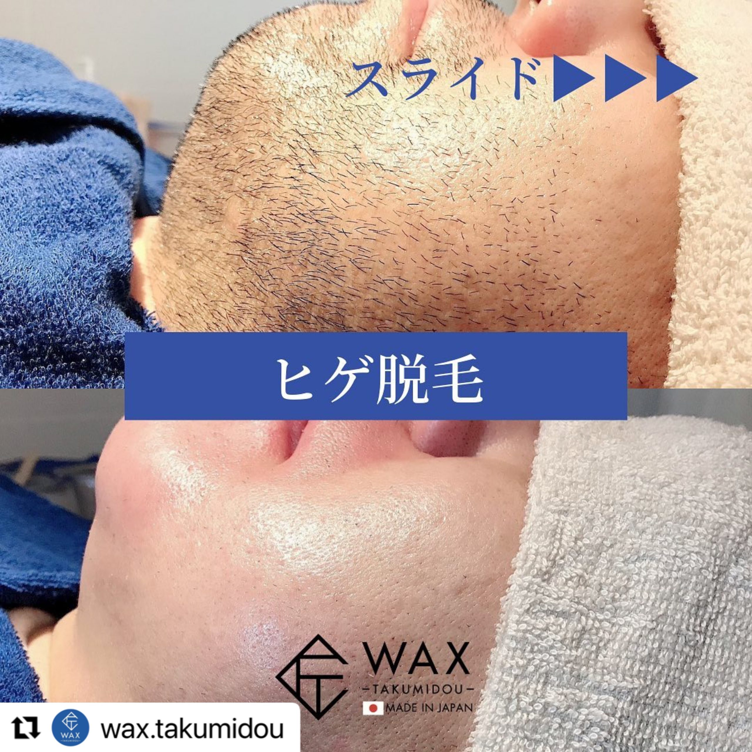 メンズ　ヒゲ　wax脱毛