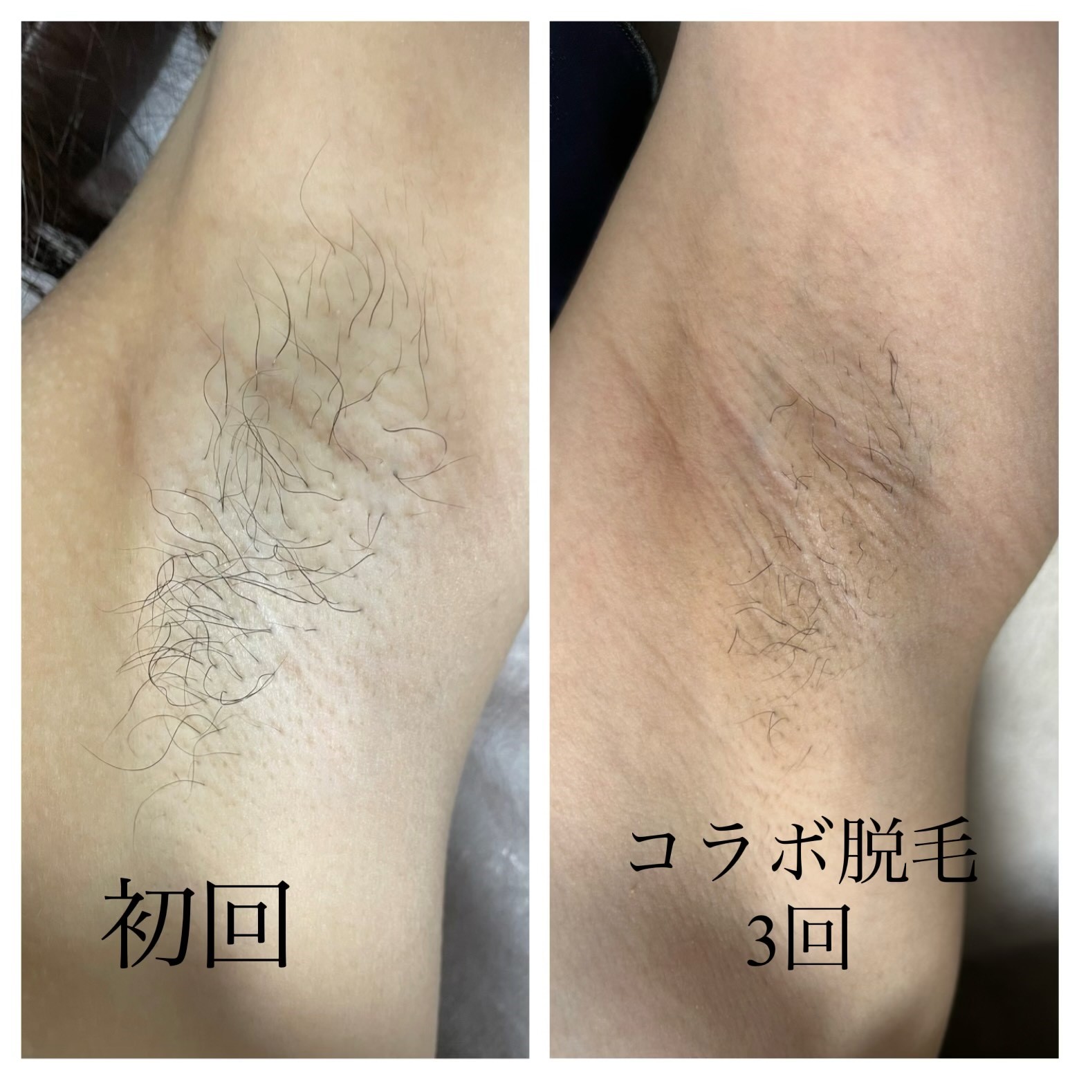 ワキ コラボ脱毛