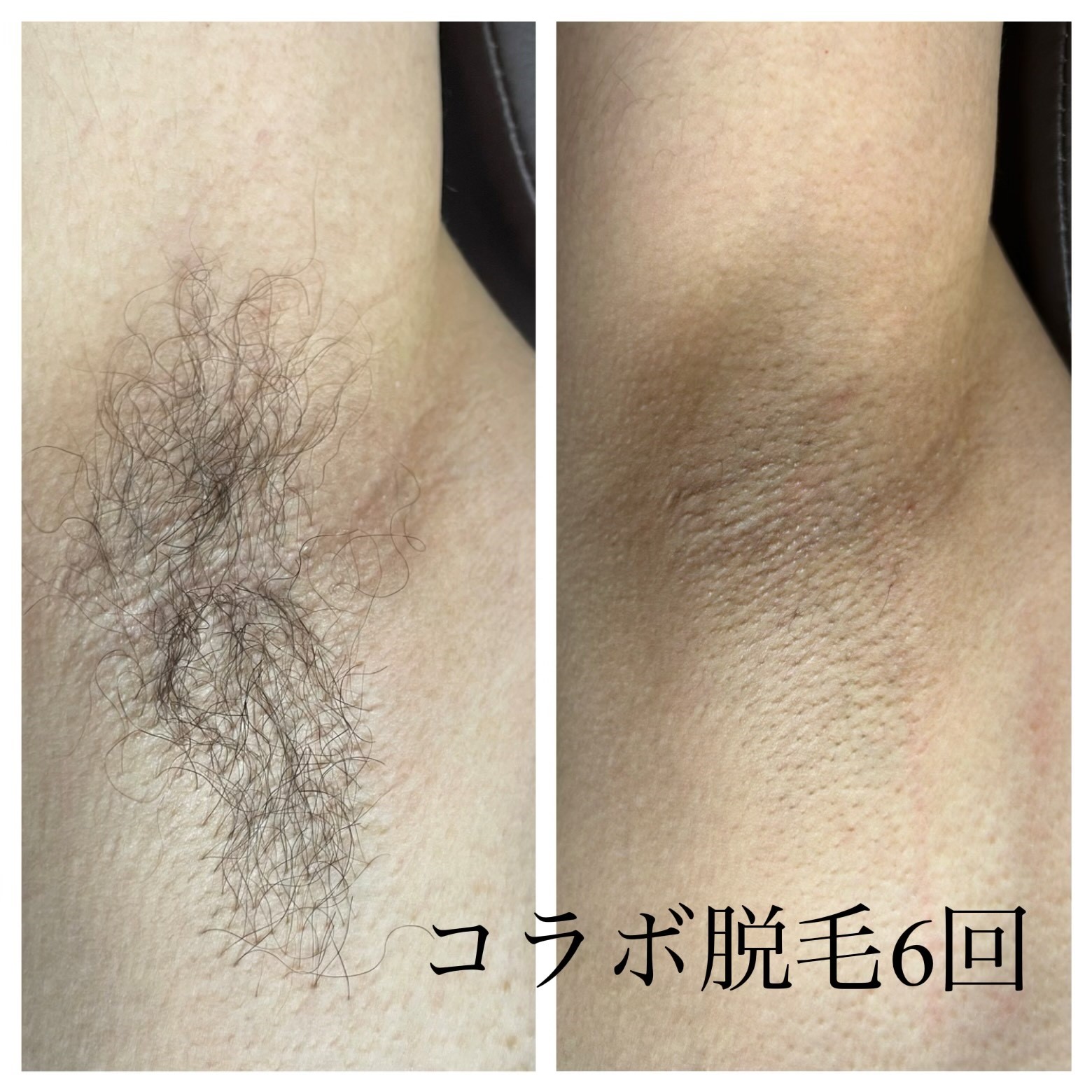 メンズ ワキ コラボ脱毛