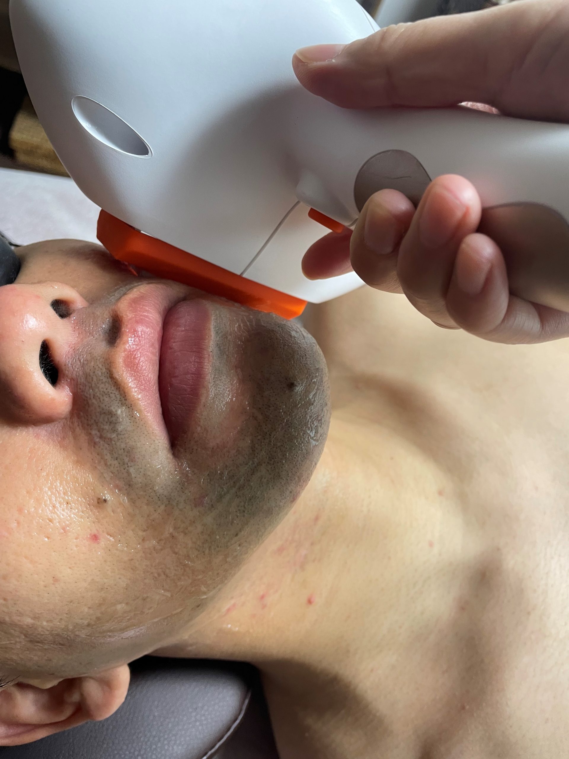 メンズ ヒゲ 光脱毛