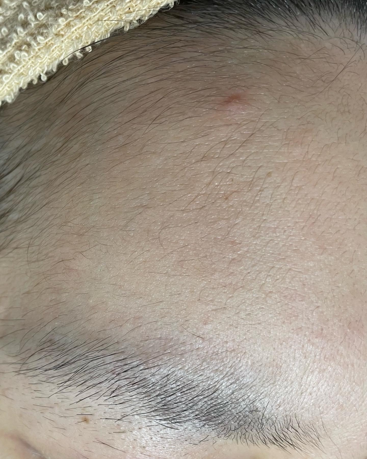 おでこ wax脱毛