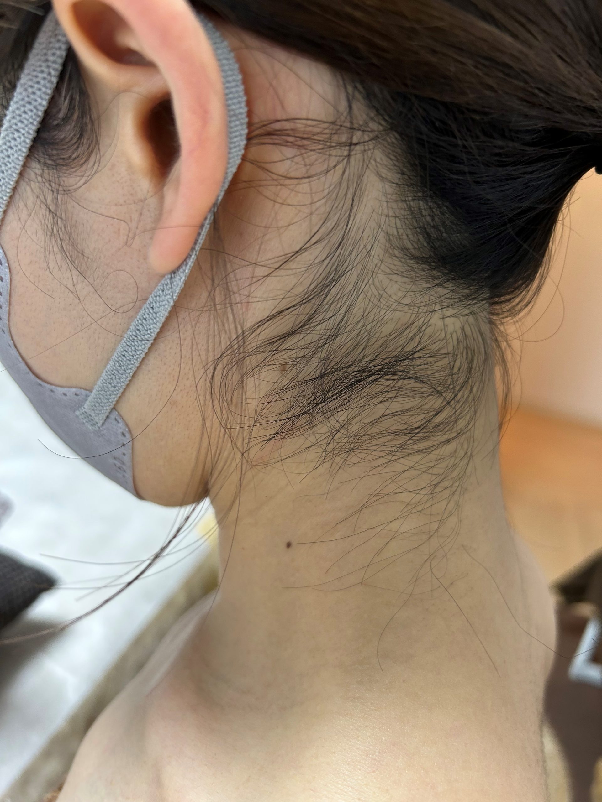 うなじ コラボ脱毛