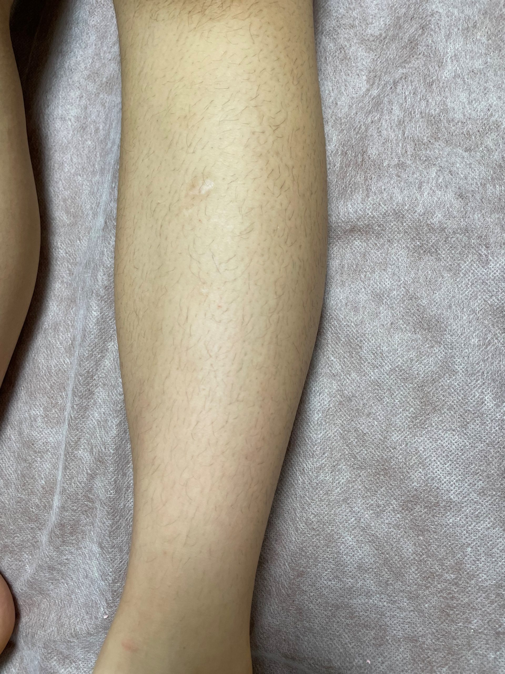 キッズ ひざ下 wax脱毛