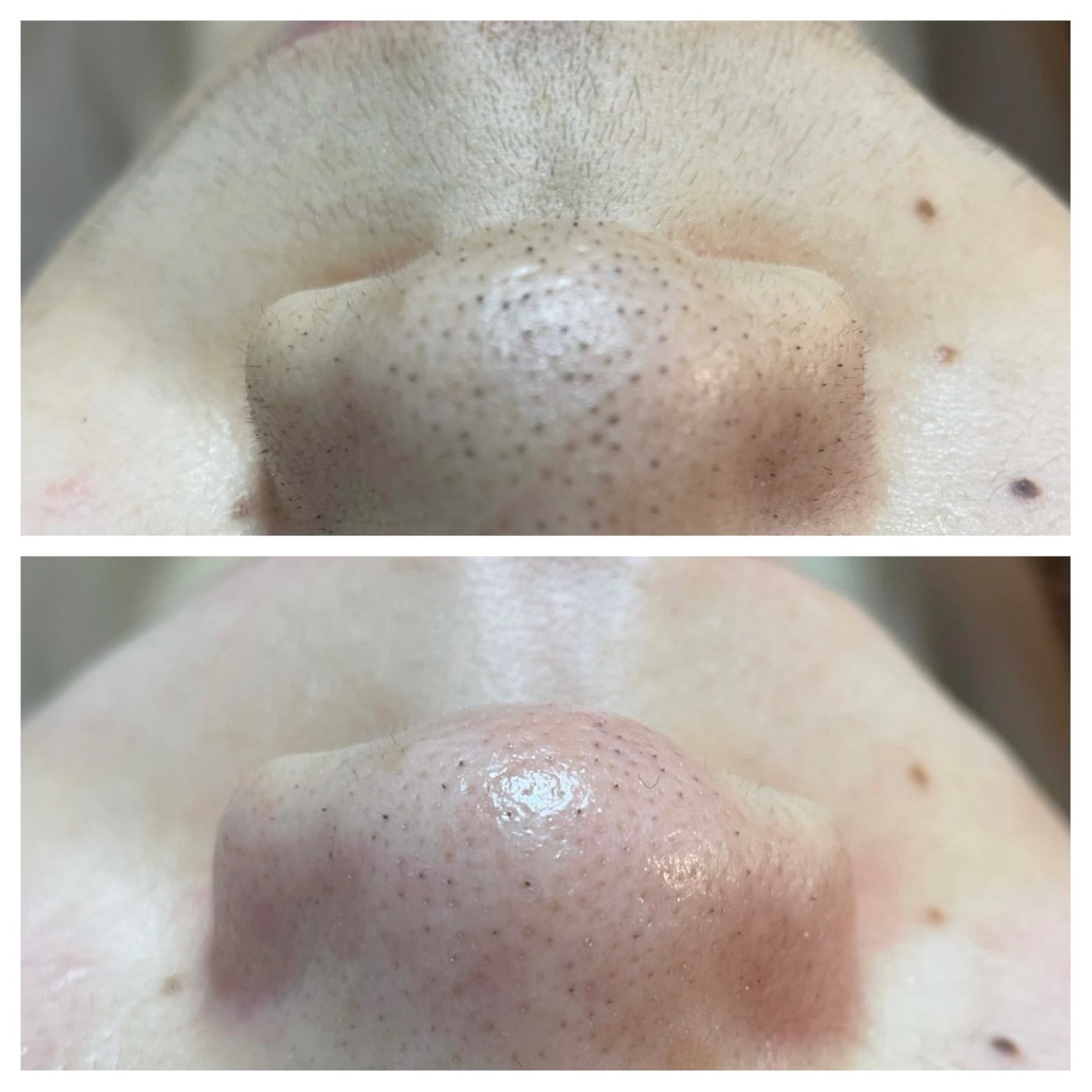 顏all wax脱毛