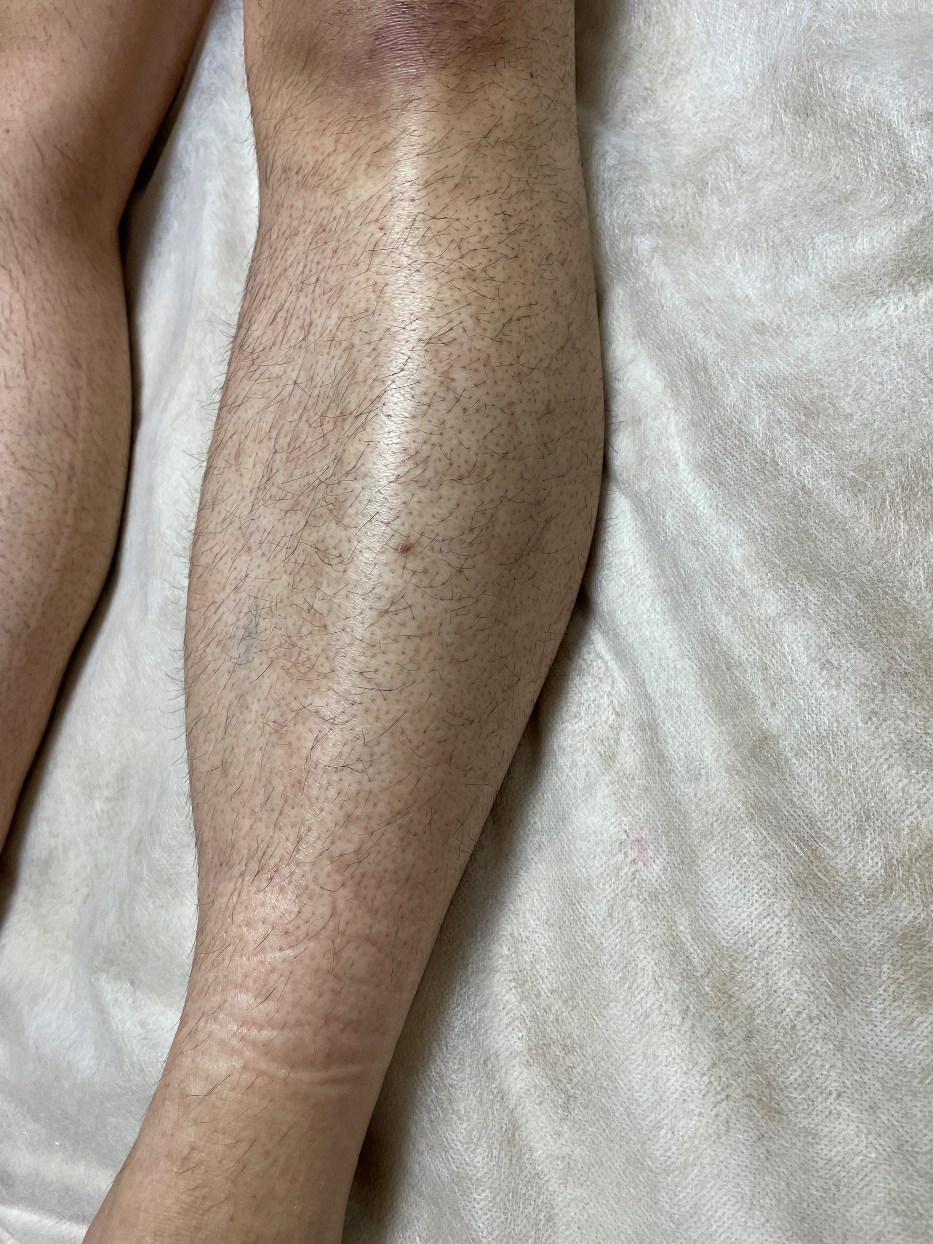 メンズ ひざ下 wax脱毛