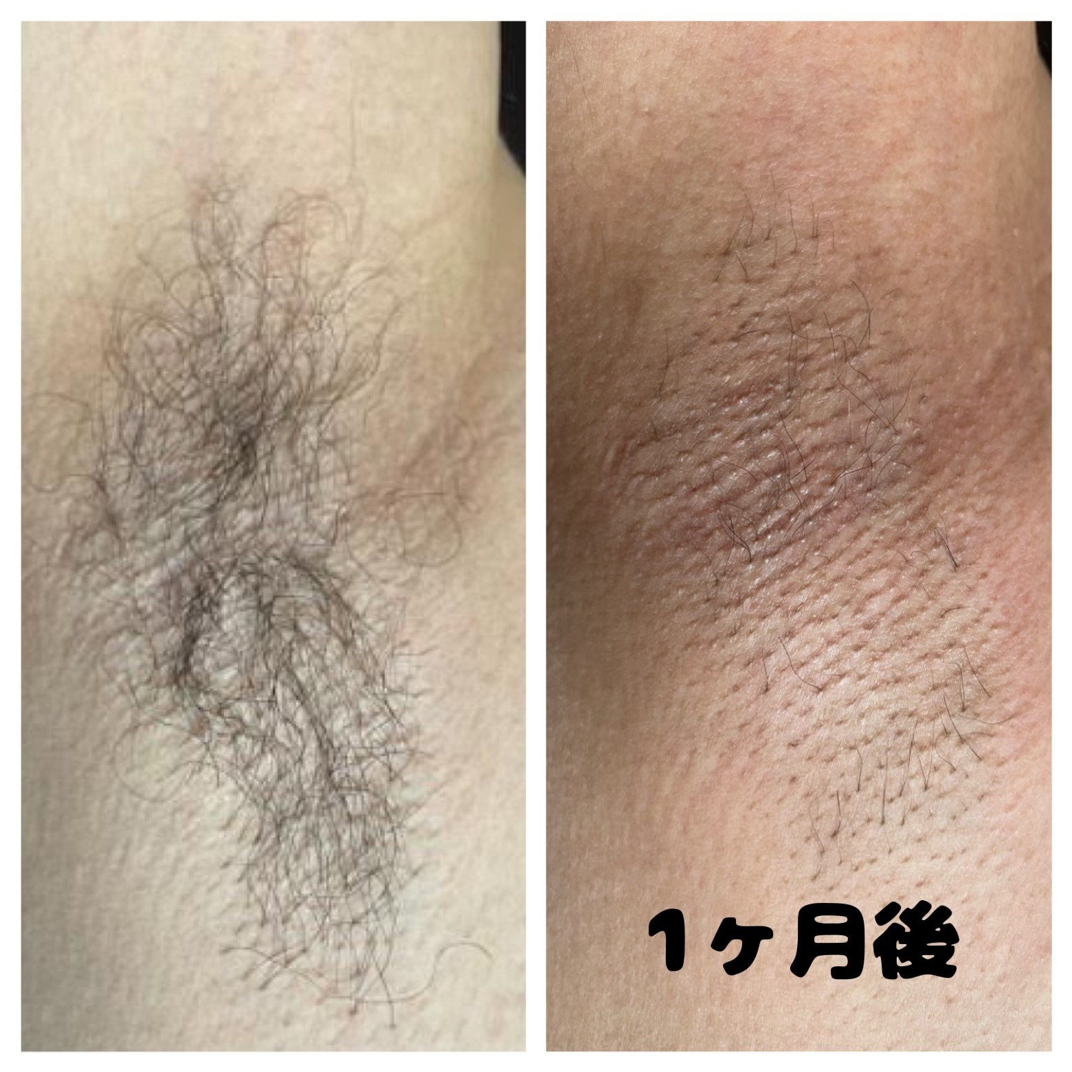 メンズ ワキ コラボ脱毛