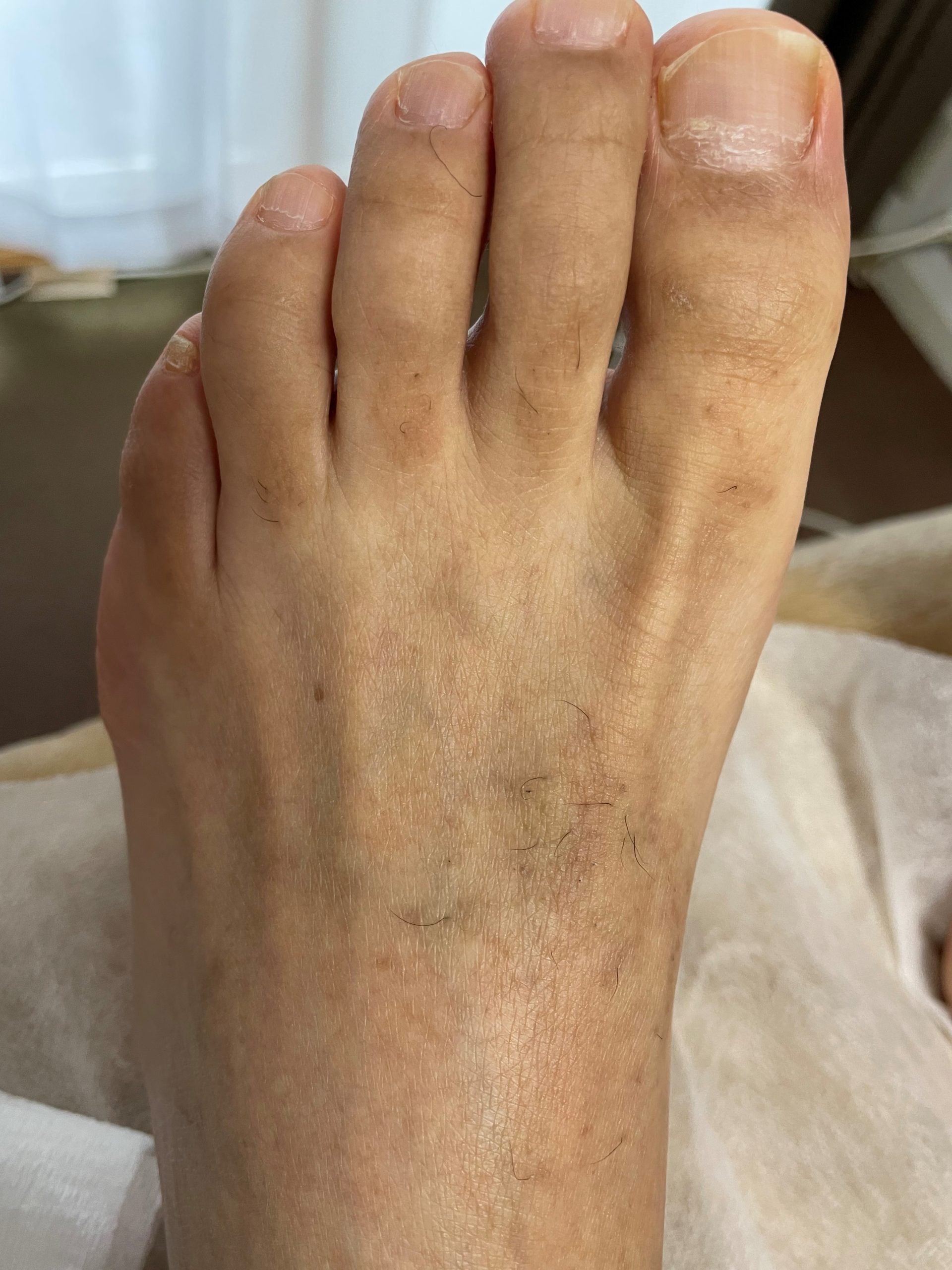 足の指　wax脱毛