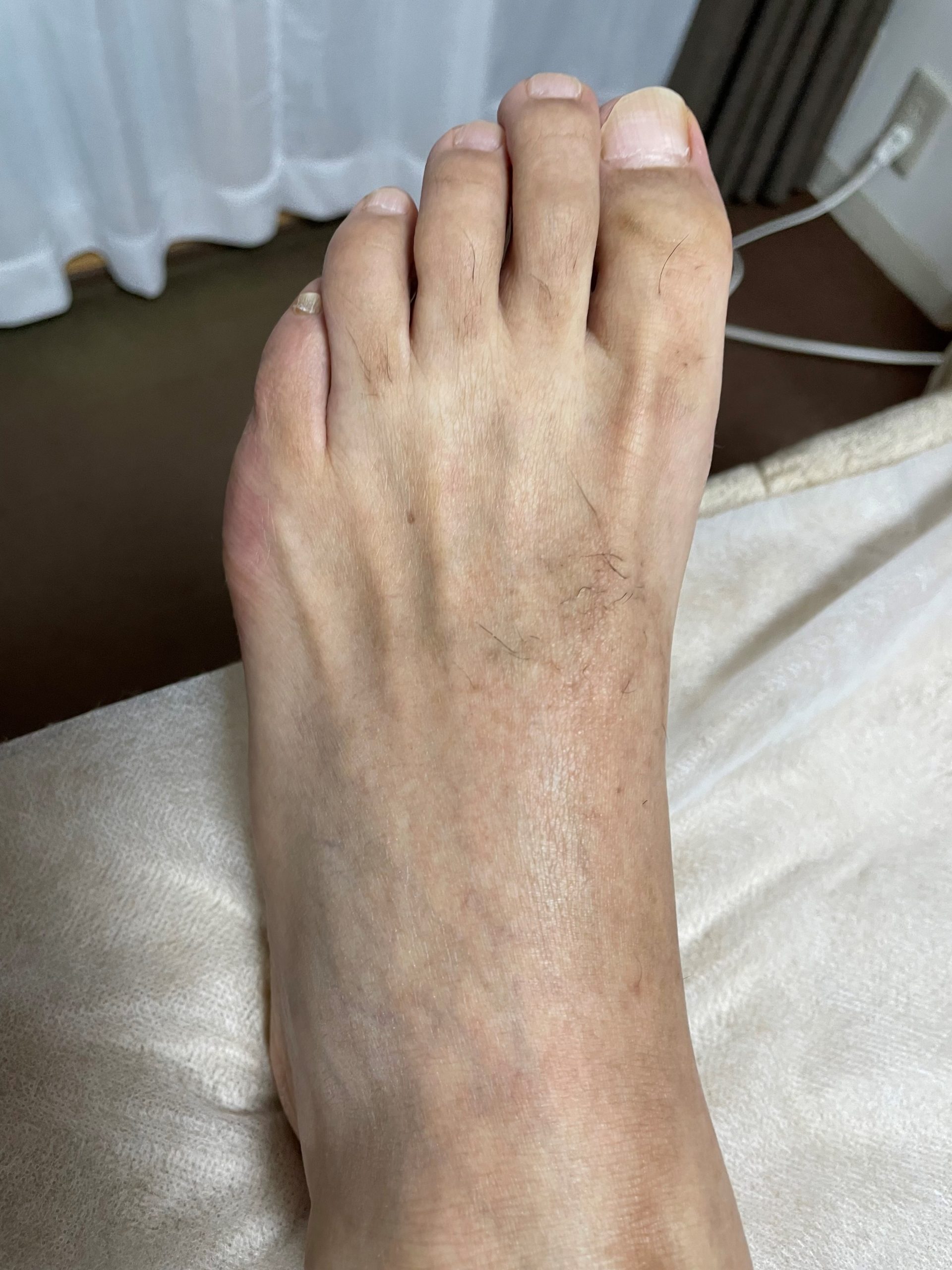 メンズ　足の指甲　ｗａｘ脱毛