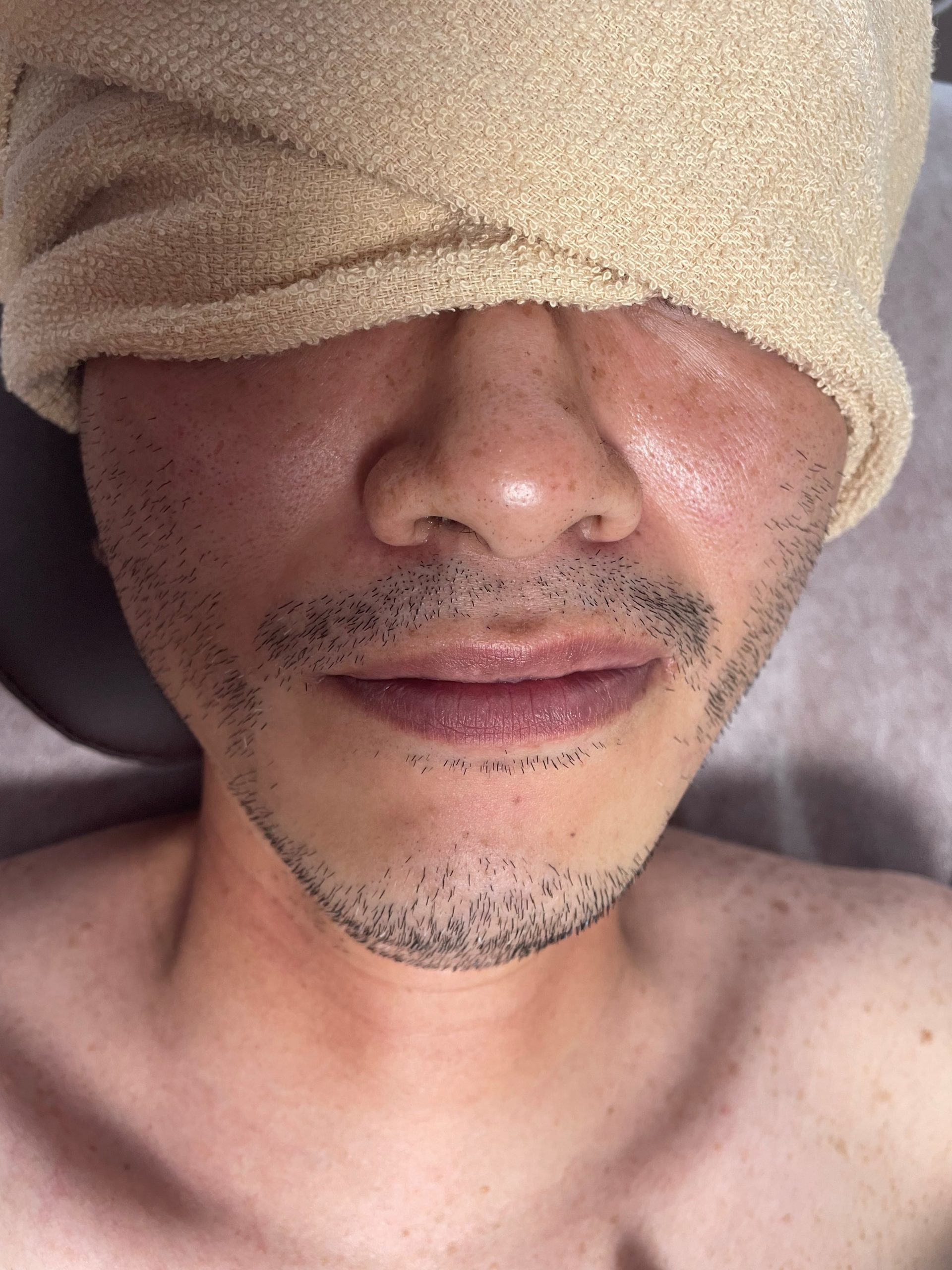 メンズ ヒゲall wax脱毛