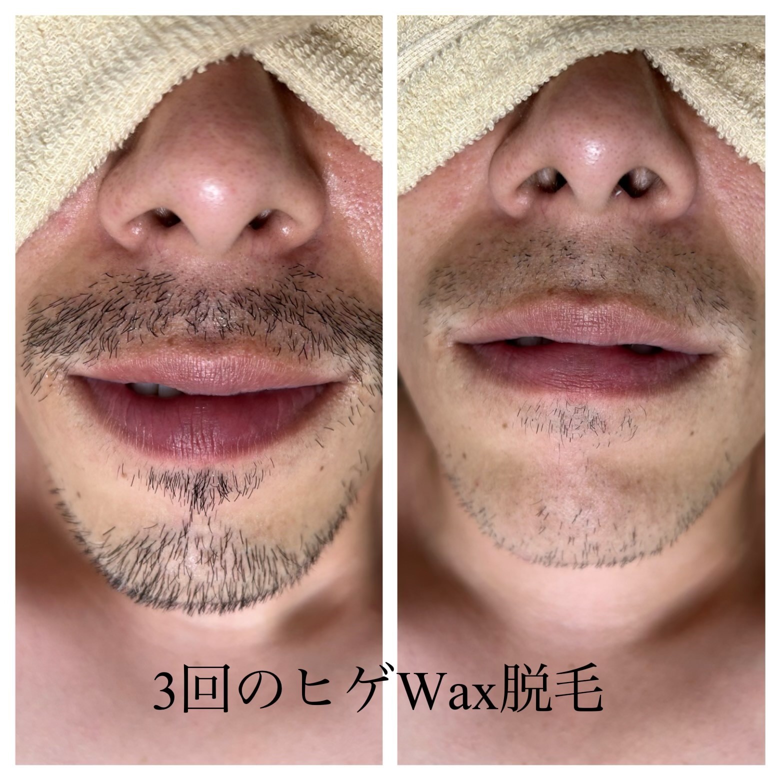 メンズ　ヒゲall　wax脱毛