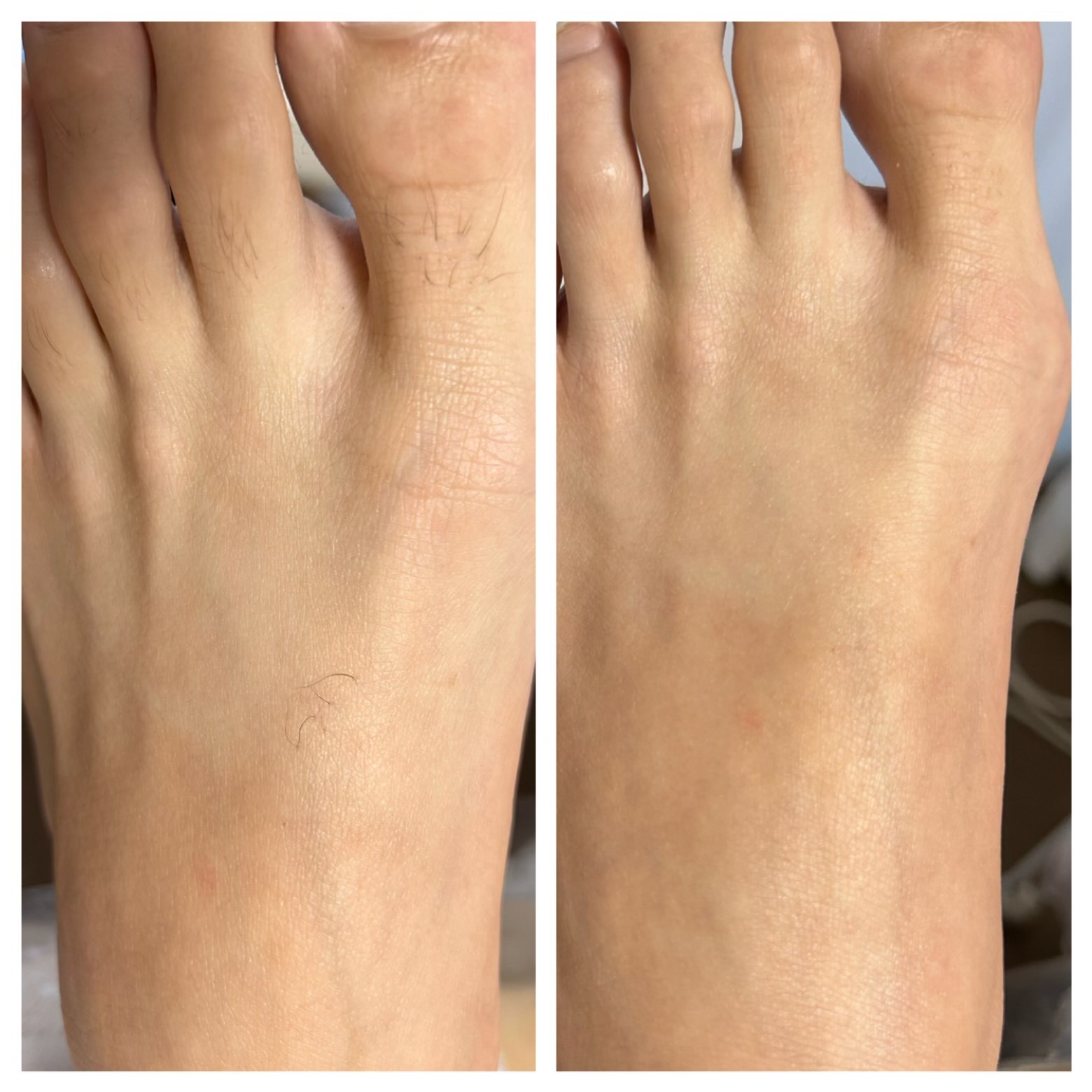 メンズ 足指甲 wax脱毛
