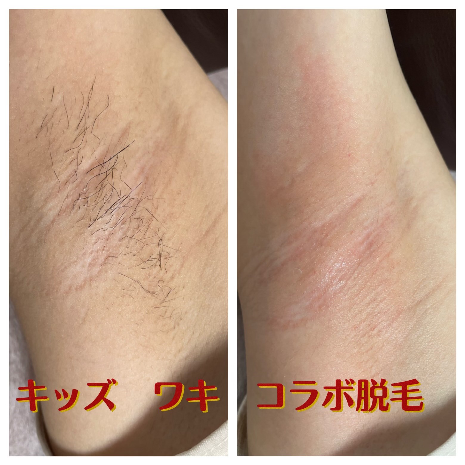 キッズ ワキ コラボ脱毛