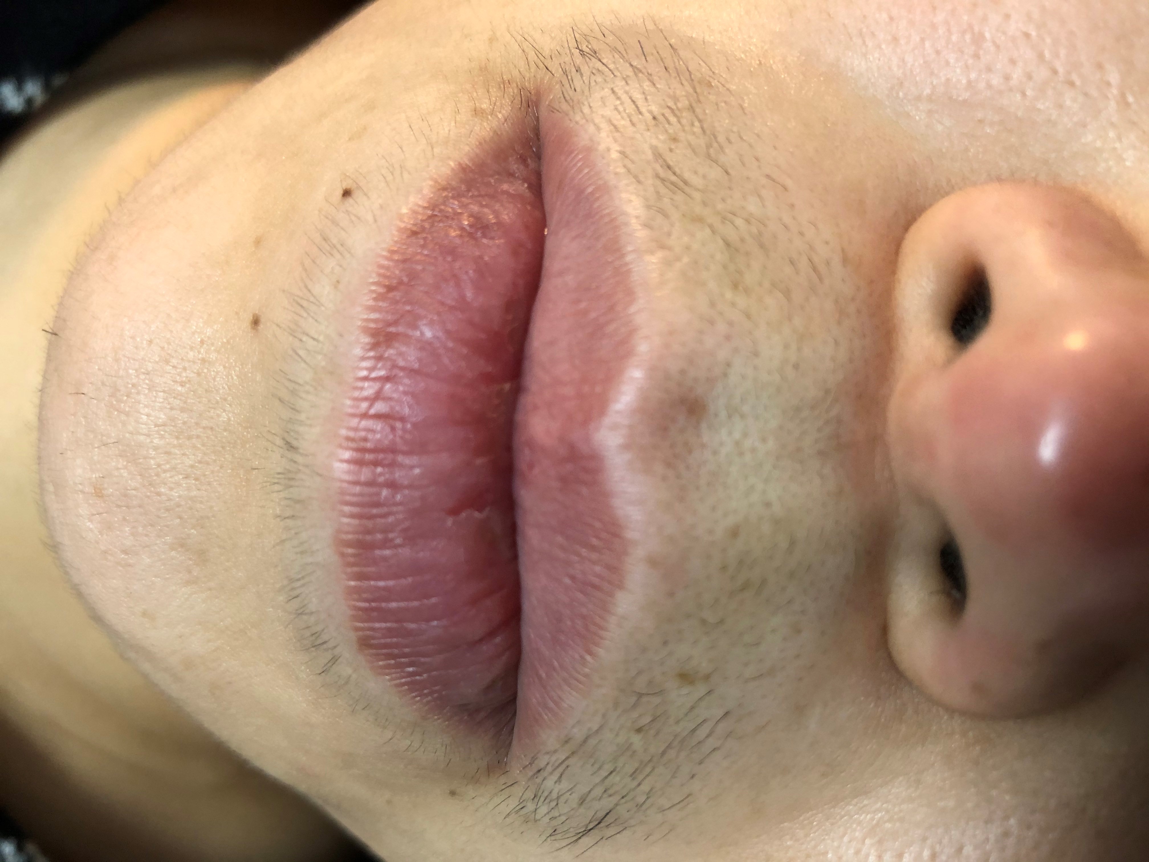 口周り wax脱毛
