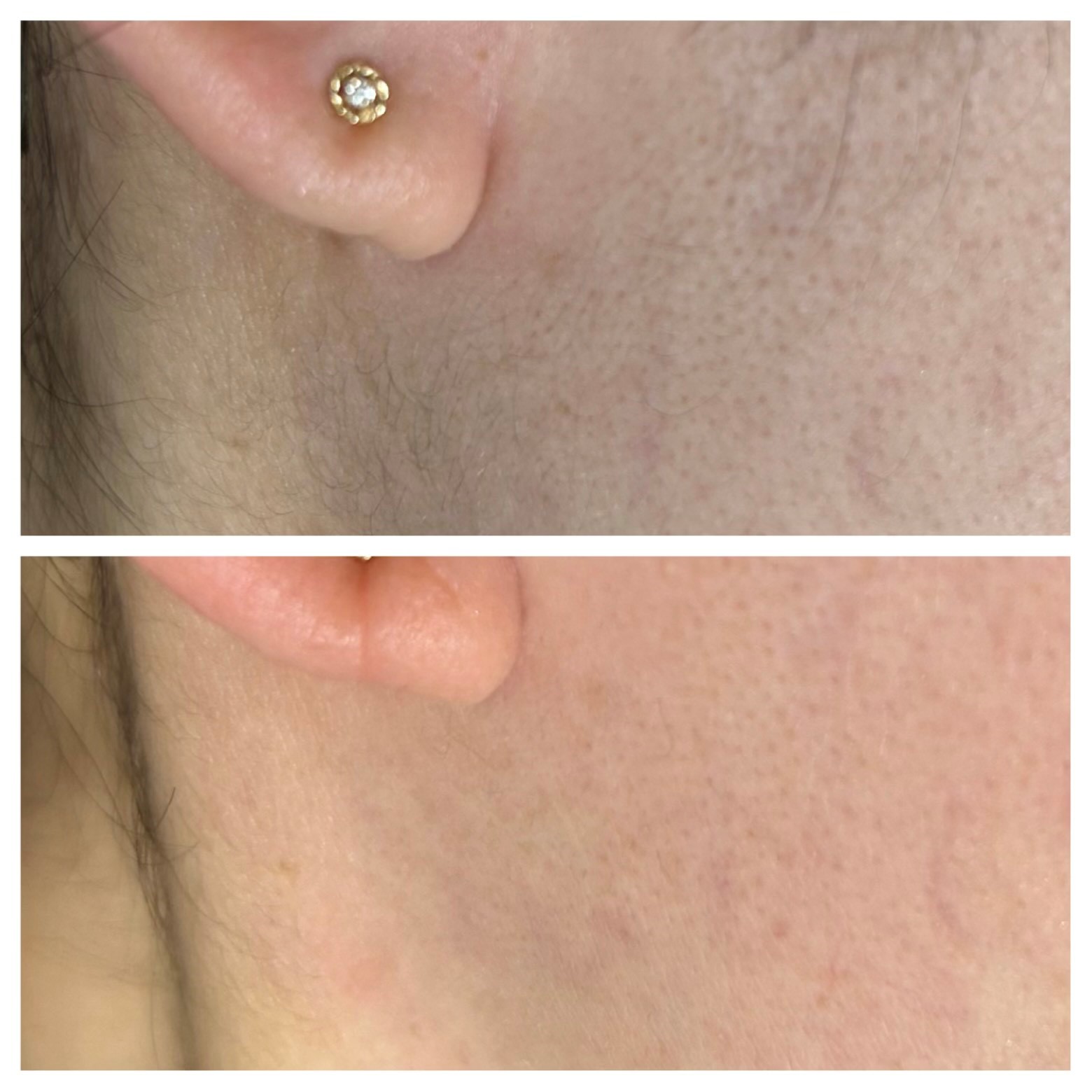 フェイスライン wax脱毛